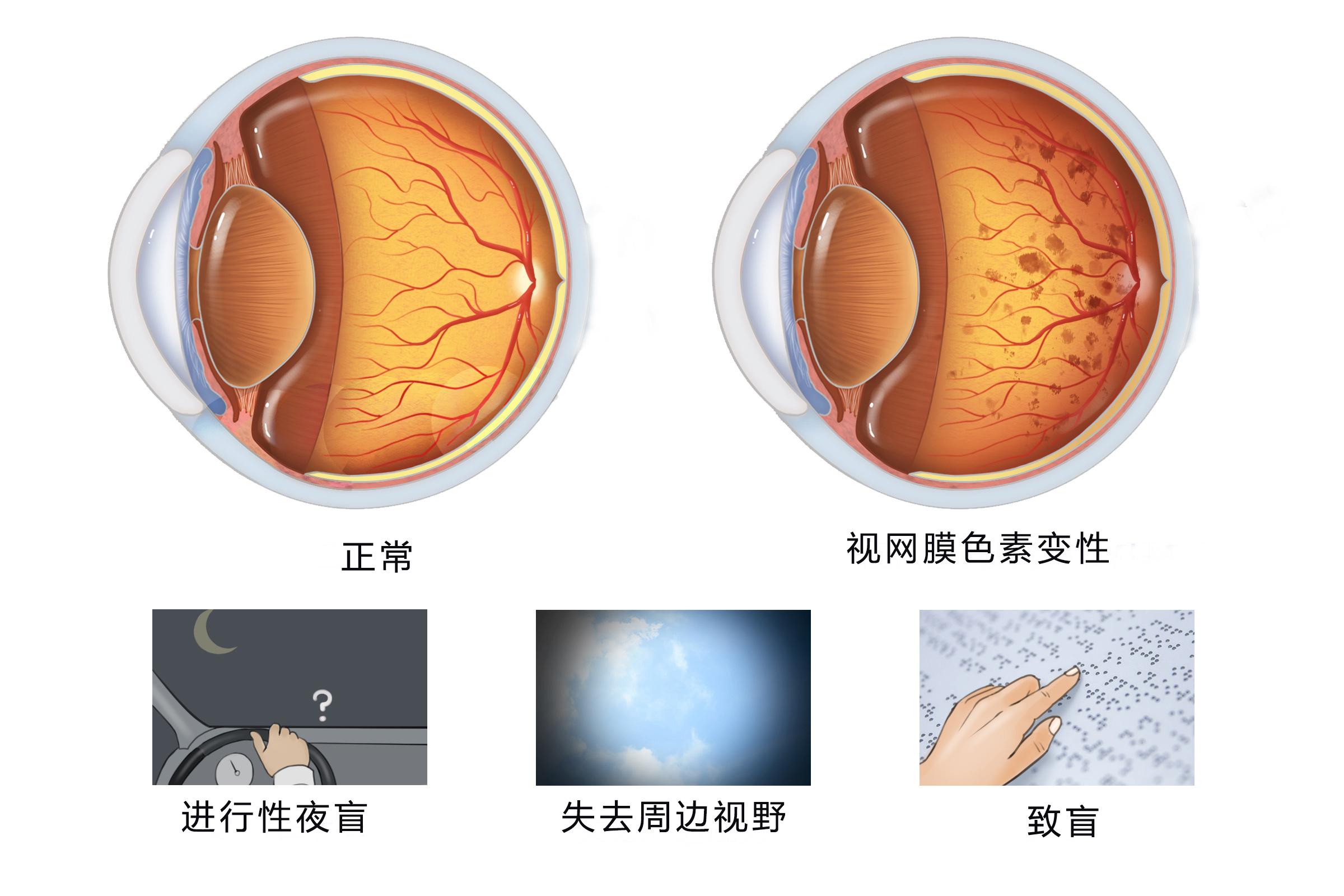 干细胞治疗视网膜色素变性的前沿进展与应用展望