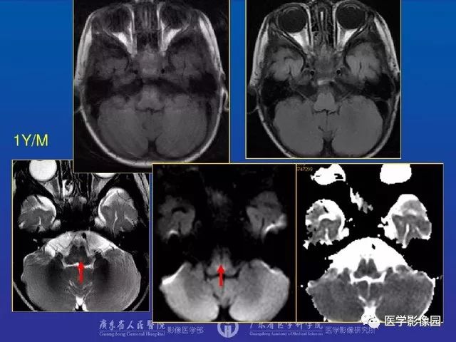 儿童神经内科专家，守护孩童神经系统健康的守护者