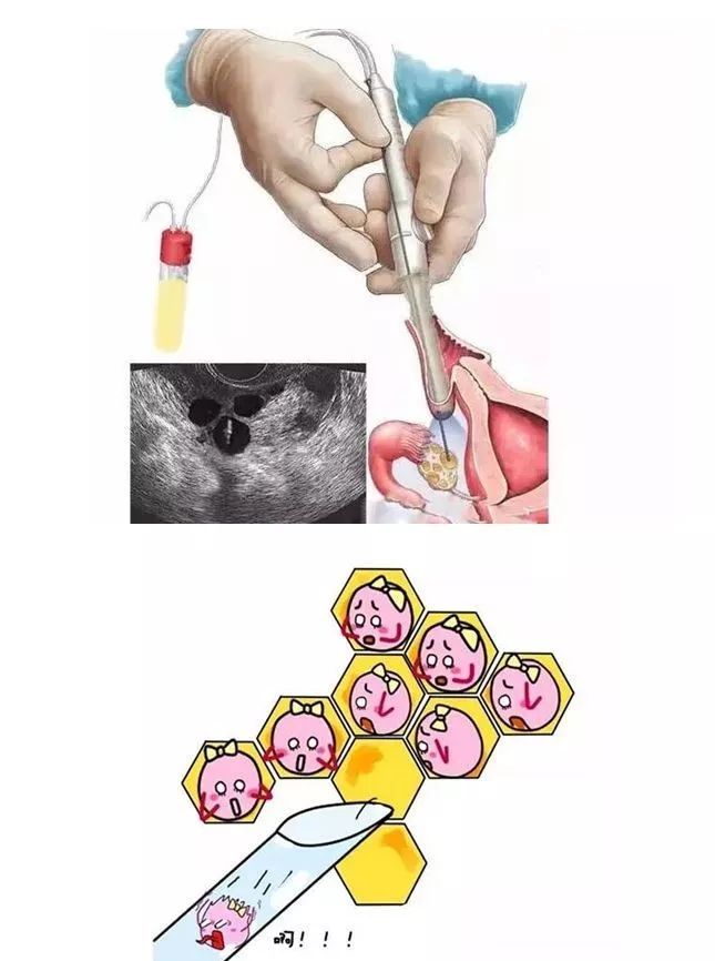 输卵管结扎后的卵子取出过程详解