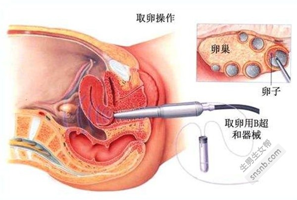 试管婴儿取卵后注意事项的重要性及其影响