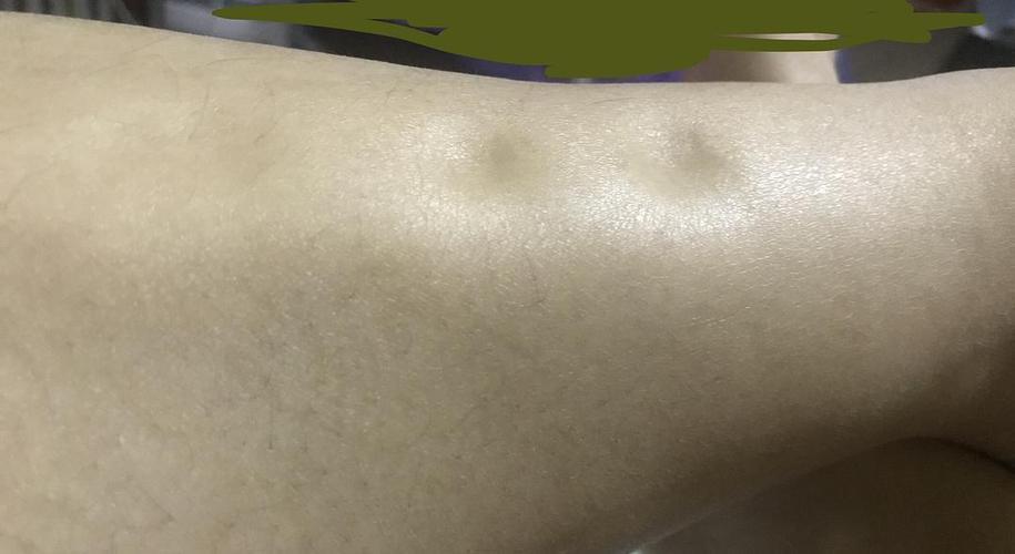 探究取卵腹水与双下肢肿胀之间的关联