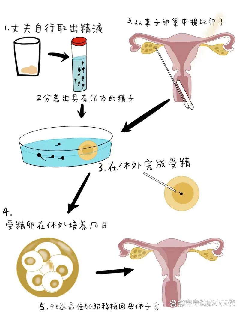 取卵过程中腹水的产生原理探究