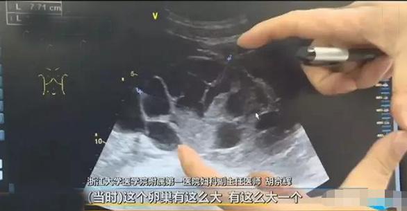 取卵后胸部腹水怎么办，应对措施与护理建议